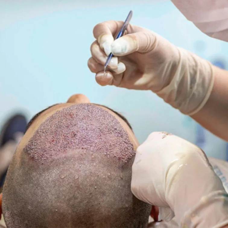 Best Hair Transplant in Karachi Pakistan - Fallego Top 1 Service