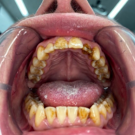 Plaque and Tartar Buildup