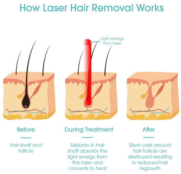 laser hair removal in karachi